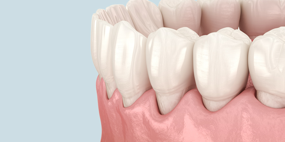 歯周病の進行・歯肉退縮による歯茎下がり