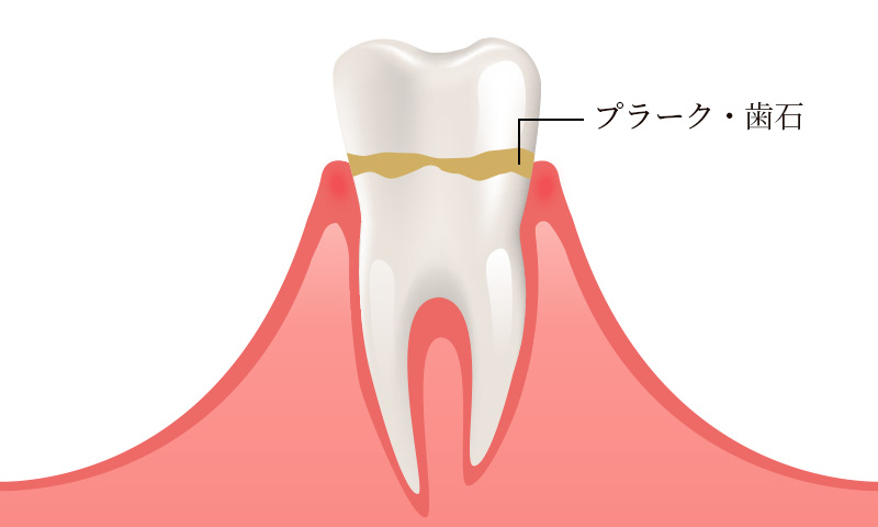 歯肉炎（初期段階の歯周病）