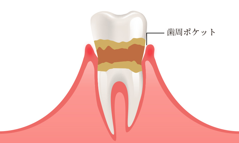 歯周炎（中等度の歯周病）