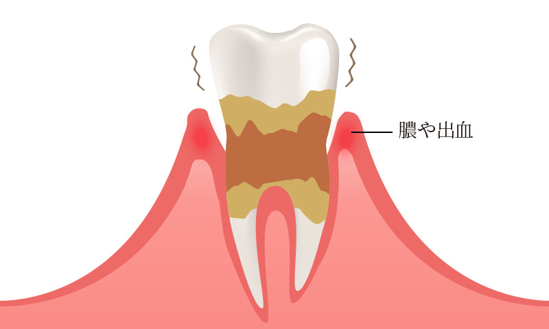 歯周炎（重度の歯周病）